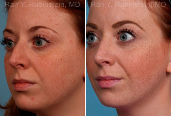 Rhinoplasty Before and After Photos in Montvale, NJ, Patient 17434