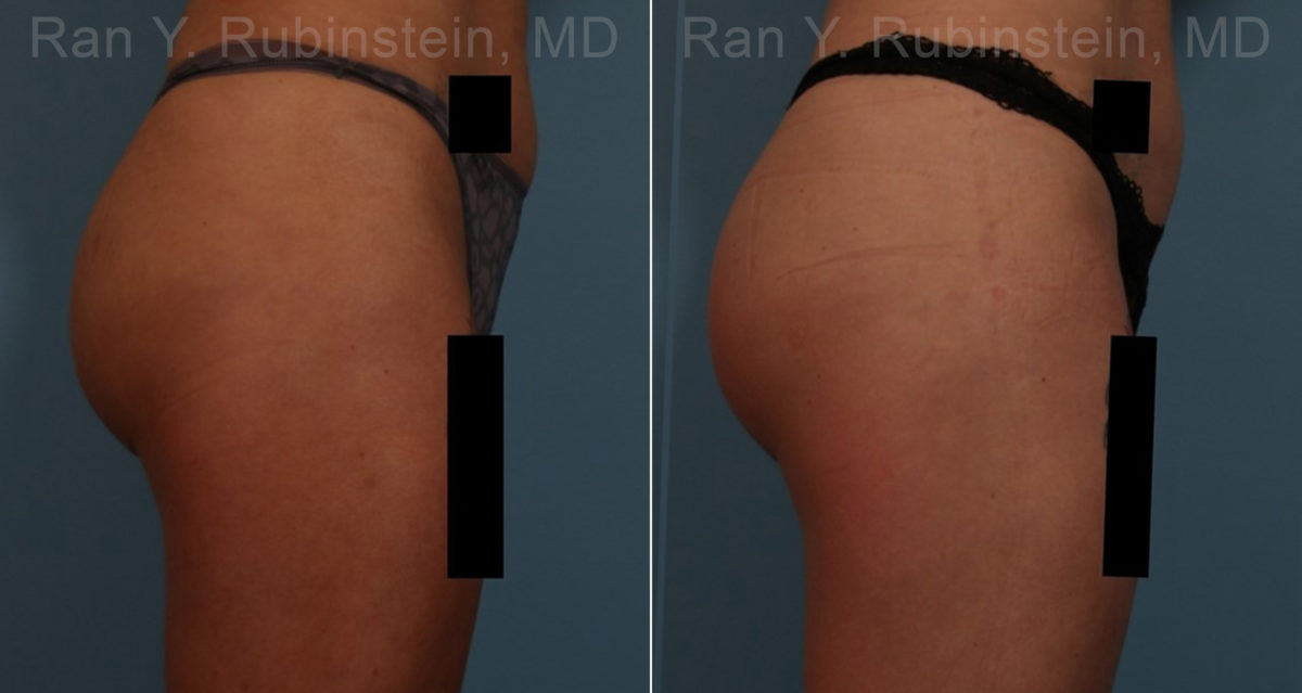 Sculptra Butt Lift Before and After Photos in Montvale, NJ, Patient 17627