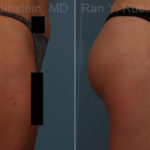 Sculptra Butt Lift Before and After Photos in Montvale, NJ, Patient 17627