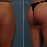 Sculptra Butt Lift Before and After Photos in Montvale, NJ, Patient 17627
