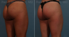Sculptra Butt Lift Before and After Photos in Montvale, NJ, Patient 17627