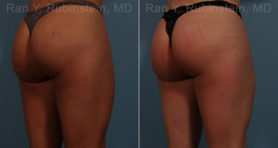Sculptra Butt Lift Before and After Photos in Montvale, NJ, Patient 17627