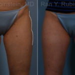 Sculptra Butt Lift Before and After Photos in Montvale, NJ, Patient 17634