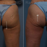 Sculptra Butt Lift Before and After Photos in Montvale, NJ, Patient 17634