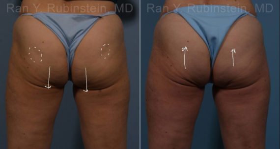 Sculptra Butt Lift Before and After Photos in Montvale, NJ, Patient 17634