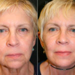 Face lift & Neck lift Before and After Photos in Montvale, NJ, Patient 12653