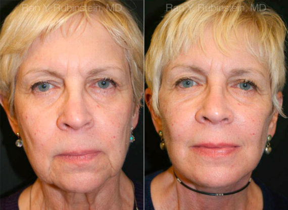Face lift & Neck lift Before and After Photos in Montvale, NJ, Patient 12653