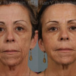 Dermal Fillers Before and After Photos in Montvale, NJ, Patient 12736