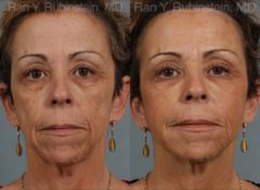 Dermal Fillers Before and After Photos in Montvale, NJ, Patient 12736