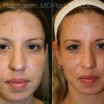 Laser Treatments Before and After Photos in Montvale, NJ, Patient 12830