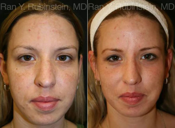 Laser Treatments Before and After Photos in Montvale, NJ, Patient 12830