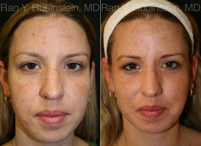 Laser Treatments Before and After Photos in Montvale, NJ, Patient 12830
