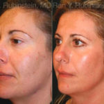 Laser Treatments Before and After Photos in Montvale, NJ, Patient 12833