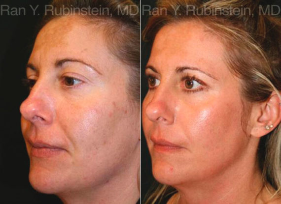 Laser Treatments Before and After Photos in Montvale, NJ, Patient 12833