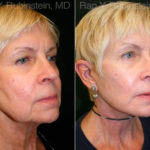 Face lift & Neck lift Before and After Photos in Montvale, NJ, Patient 12653