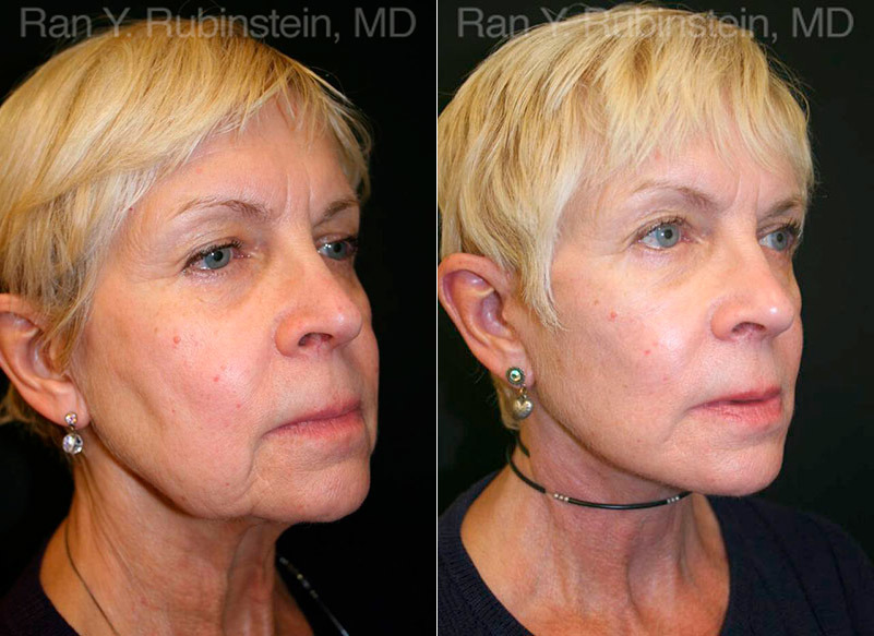 Face lift & Neck lift Before and After Photos in Montvale, NJ, Patient 12653
