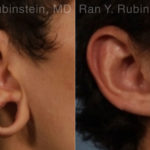 Earlobe Repair Before and After Photos in Montvale, NJ, Patient 19161