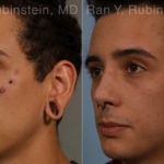 Earlobe Repair Before and After Photos in Montvale, NJ, Patient 19161