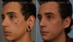 Earlobe Repair Before and After Photos in Montvale, NJ, Patient 19161