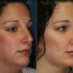 Smart Lipo Neck Before and After Photos in Montvale, NJ, Patient 13283
