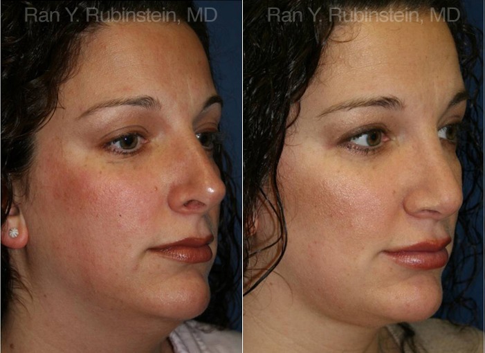 Smart Lipo Neck Before and After Photos in Montvale, NJ, Patient 13283