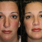 Smart Lipo Neck Before and After Photos in Montvale, NJ, Patient 13283