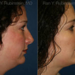 Smart Lipo Neck Before and After Photos in Montvale, NJ, Patient 13283