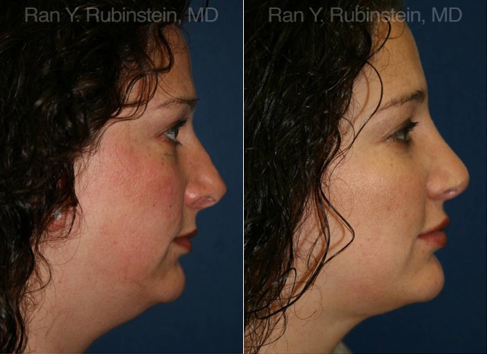 Smart Lipo Neck Before and After Photos in Montvale, NJ, Patient 13283