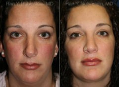 Smart Lipo Neck Before and After Photos in Montvale, NJ, Patient 13283