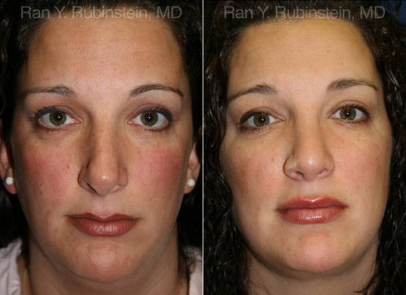 Smart Lipo Neck Before and After Photos in Montvale, NJ, Patient 13283
