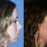 Smart Lipo Neck Before and After Photos in Montvale, NJ, Patient 13290