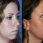 Smart Lipo Neck Before and After Photos in Montvale, NJ, Patient 13290