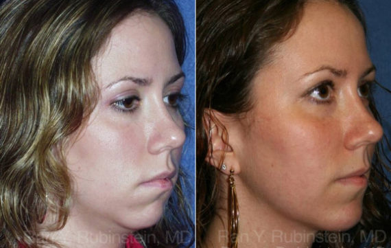 Smart Lipo Neck Before and After Photos in Montvale, NJ, Patient 13290