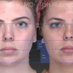 Chin Filler Before and After Photos in Montvale, NJ, Patient 20118