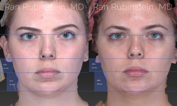 Chin Filler Before and After Photos in Montvale, NJ, Patient 20118