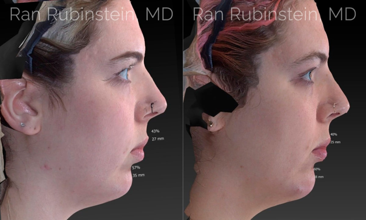 Chin Filler Before and After Photos in Montvale, NJ, Patient 20118