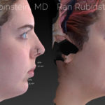 Chin Filler Before and After Photos in Montvale, NJ, Patient 20118