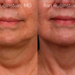 Laser Lift Precision Tx Before and After Photos in Montvale, NJ, Patient 20459