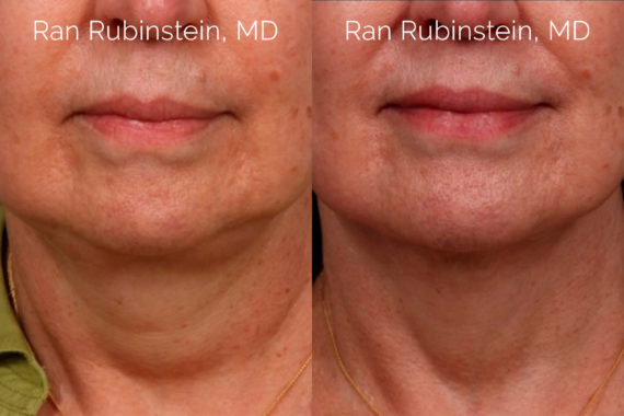 Laser Lift Precision Tx Before and After Photos in Montvale, NJ, Patient 20459