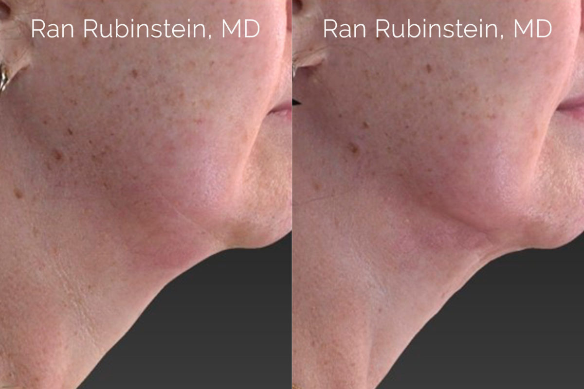 Laser Lift Precision Tx Before and After Photos in Montvale, NJ, Patient 20459
