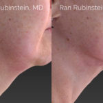 Laser Lift Precision Tx Before and After Photos in Montvale, NJ, Patient 20459