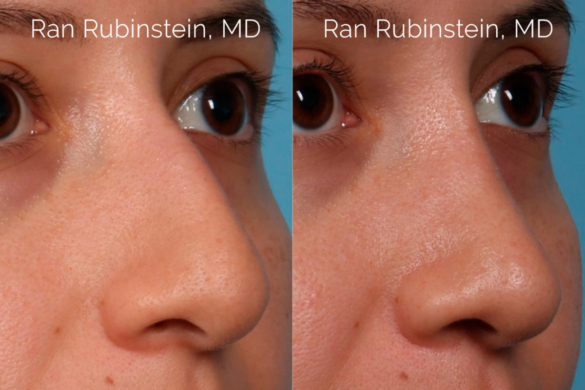 Ethnic Rhinoplasty Before and After Photos in Montvale, NJ, Patient 20466