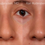 Ethnic Rhinoplasty Before and After Photos in Montvale, NJ, Patient 20466