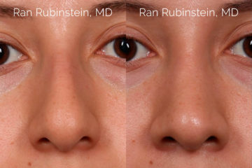 Ethnic Rhinoplasty Before and After Photos in Montvale, NJ, Patient 20466