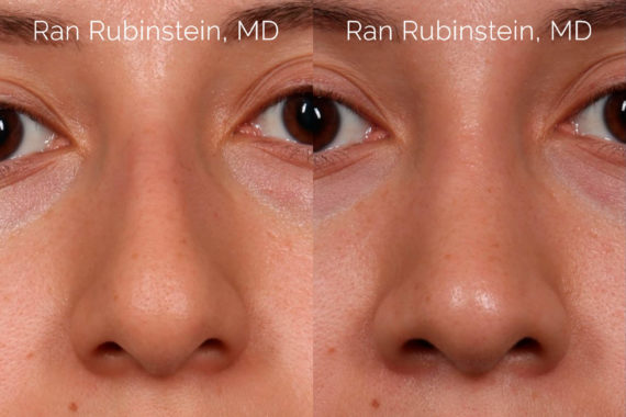 Ethnic Rhinoplasty Before and After Photos in Montvale, NJ, Patient 20466