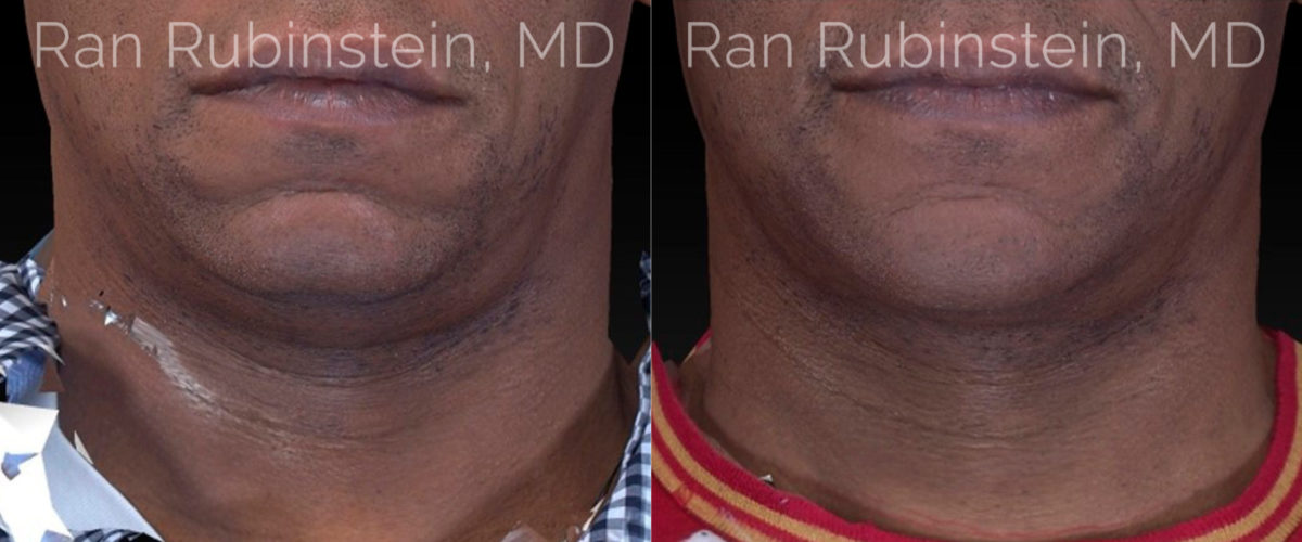 Chin Filler Before and After Photos in Montvale, NJ, Patient 20743