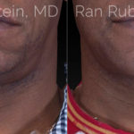 Chin Filler Before and After Photos in Montvale, NJ, Patient 20743