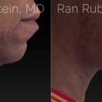 Chin Filler Before and After Photos in Montvale, NJ, Patient 20743