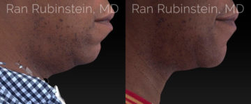 Chin Filler Before and After Photos in Montvale, NJ, Patient 20743