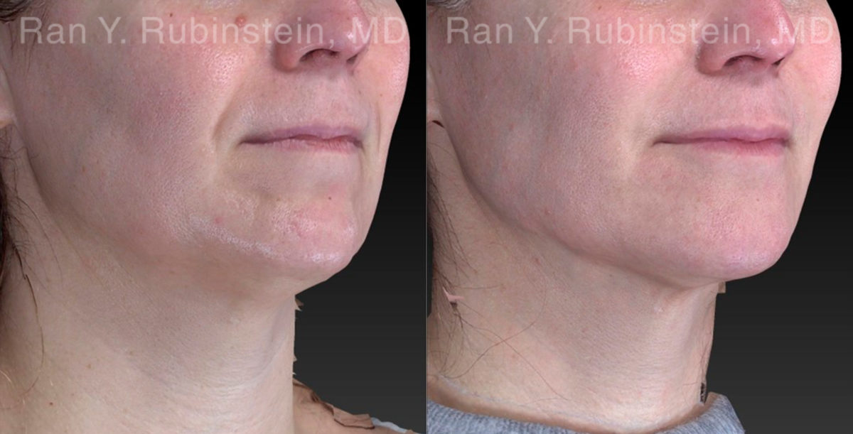 Chin Filler Before and After Photos in Montvale, NJ, Patient 21103